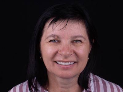 Прямі вініри