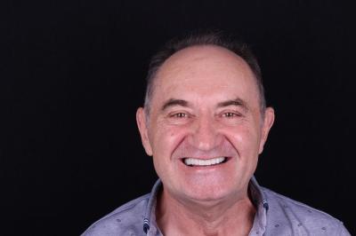 Імплантація Зубів 4 All On | Ali’s Premium Dental Care