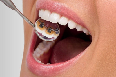 Лінгвальні Брекети Ціна - Франківськ | Ali’s Premium Dental