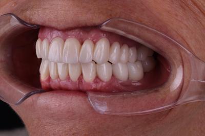 Коронки Цирконій - Коронки з Цирконію Ціна | Ali’s Premium