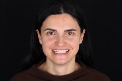 Металокерамічна Коронка у Франківську | Ali’s Premium Dental