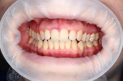 Професійна Чистка Зубів | Ali’s Premium Dental Care