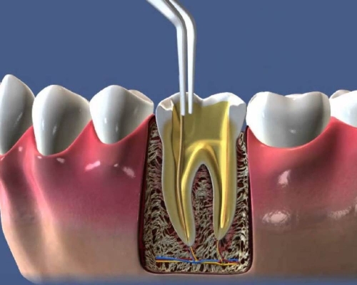 лікування зубів під мікроскопом івано франківськ, ціна, ендодонтія під мікроскопом