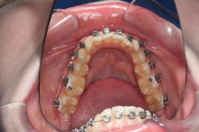 Брекети на Нижню Щелепу | Ali’s Premium Dental Care