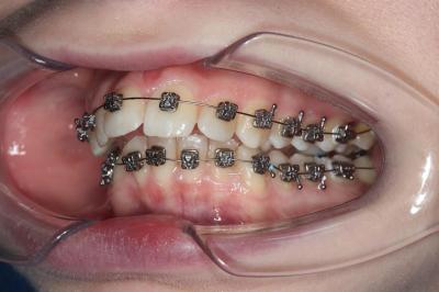 Відкритий Прикус Виправлення | Ali’s Premium Dental Care