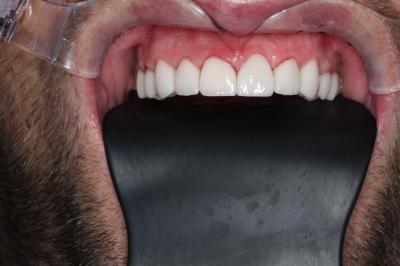 Нейлонові Зубні Протези Ціна | Ali’s Premium Dental Care