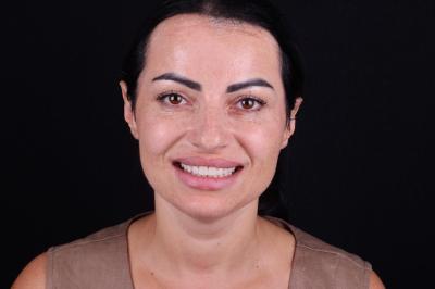 Зубні Протези Коронки - Івано-Франківськ | Ali’s Premium