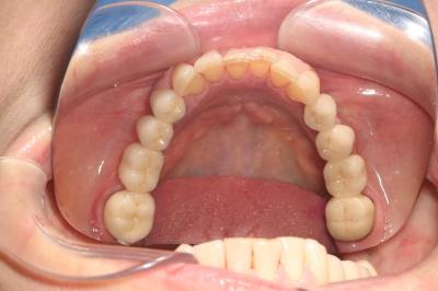 Комплексна Чистка Зубів | Ali’s Premium Dental Care