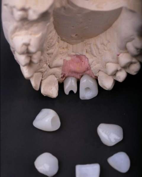 Зубні Протези Ціни - Протезування Зубів | Ali’s Premium Dental 