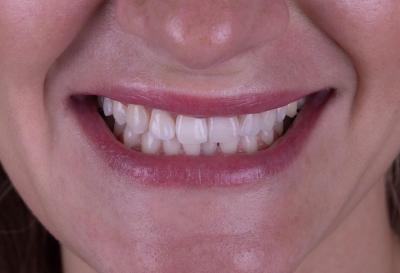 Фотовідбілювання Зубів | Франківськ | Ali’s Premium Dental Care