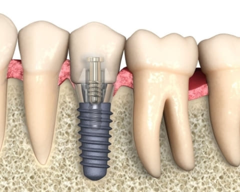 Ціна Зубних Імплантатів | Франківськ | Ali’s Premium Dental Care