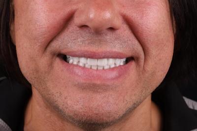 Керамічні Вініри Ціна Івано-Франківськ | Ali’s Premium Dental
