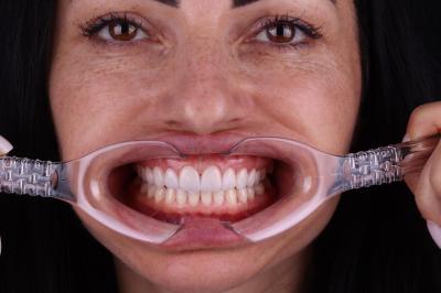 Композитні Вініри Ціна - Франківськ | Ali’s Premium Dental