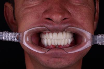 Одномоментна Імплантація | Франківськ | Ali’s Premium Dental