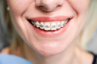 Брекети Самолігуючі Ціна в Франківську | Ali’s Premium Dental