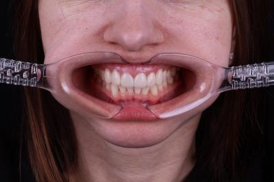 Ціни на Коронки для Зубів - Франківськ | Ali’s Premium Dental