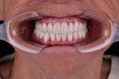 Пластмасові Коронки Ціна | Франківськ | Ali’s Premium Dental