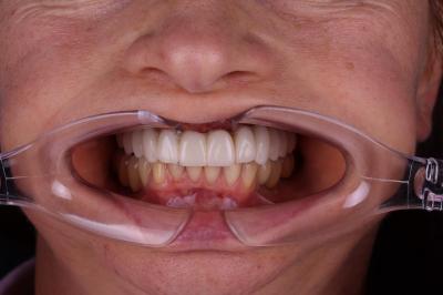 Повна Імплантація в Івано-Франківську | Ali’s Premium Dental