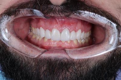 Адгезивний Мостоподібний Протез | Ali’s Premium Dental Care