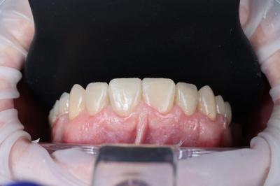 Протезування Передніх Зубів | Ali’s Premium Dental Care