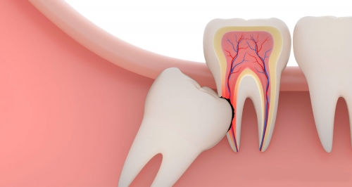 Видалення Зуба | Івано-Франківськ | Ali’s Premium Dental Care