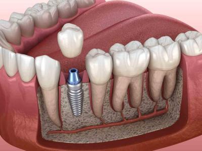 Имплантация зубов. Зубные импланты Ali’s Premium Dental Care, Имплантация зубов. Зубные импланты стоматологическая клиника, стоматологическая клиника Ивано-Франковск